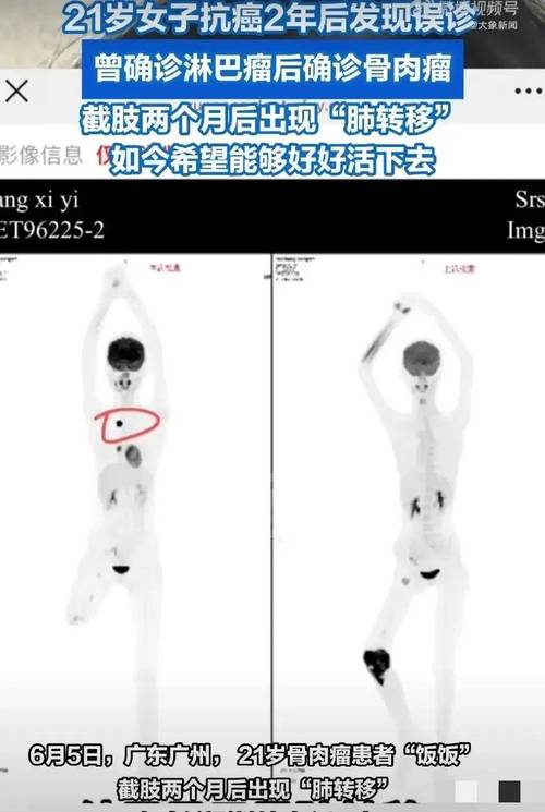4949澳门特马今晚开奖53期今和抗癌2年后发现误诊与抗癌2年后发现误诊怎么办